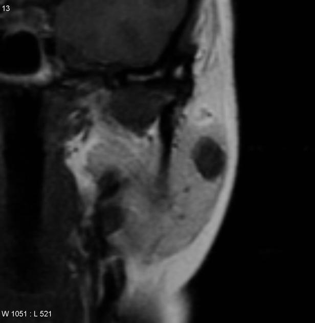 MRI showing coronal T1 parotid adenocarcinoma[5]