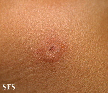 File:Dermatitis herpetiformis32.jpg