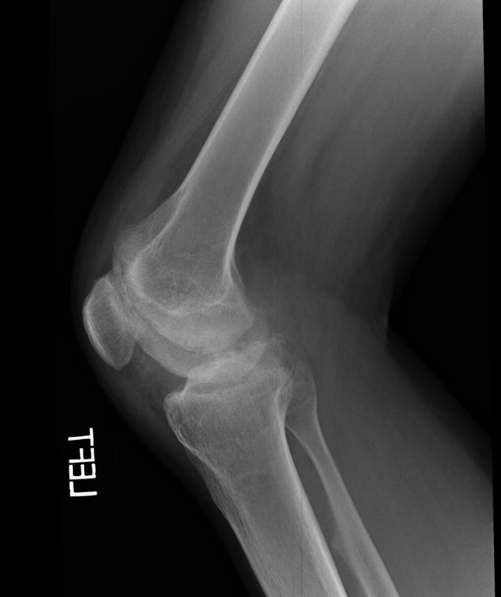 X-ray of the knee in a patient with Hemophilia