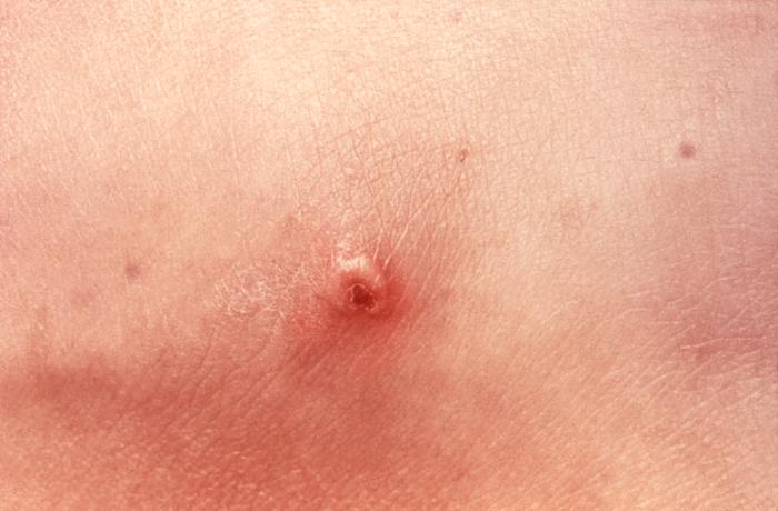 This patient presented with a cutaneous lesion that was traced to a systemically disseminated gonoccal infection. Though a sexually transmitted disease, if a Gonorrhea infection is allowed to go untreated, the Neisseria gonorrhea bacteria responsible for the infection can become disseminated throughout the body, forming lesions in extra-genital locations. Adapted from CDC