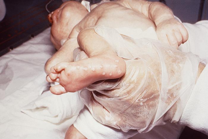 This neonate displayed a maculopapular outbreak on his feet due to congenitally acquired herpes simplex virus. In this instance, due to the age of the patient, this condition is known as herpes simplex neonatorum. See PHIL 15115, for a closer view of these lesions. Genital HSV can cause potentially fatal infections in babies. It is important that women avoid contracting herpes during pregnancy because a first episode during pregnancy causes a greater risk of transmission to the baby. If a woman has active genital herpes at delivery, a cesarean delivery is usually performed. Fortunately, infection of a baby from a woman with herpes infection is rare. Adapted from CDC