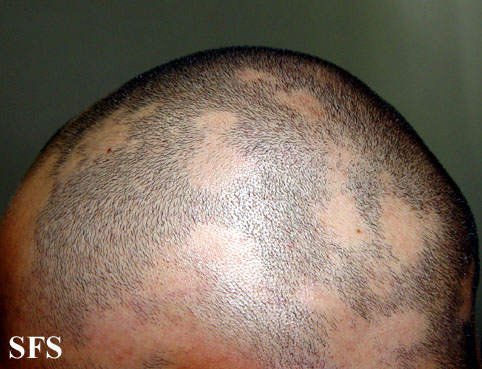 File:Alopecia areata 12.jpeg