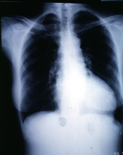 Chest X-ray: Left Ventricular Hypertrophy in a patient with aortic valve stenosis