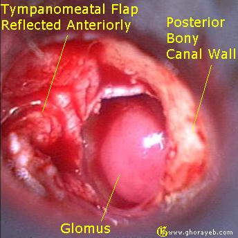Surgical picture of glomus tympanicum in the eft middle ear. The tympanomeatal flap has been raised and reflected anteriorly[7].