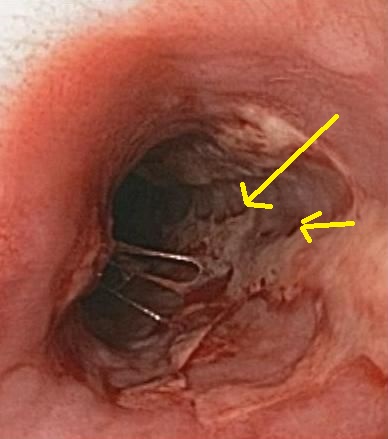 File:Herpes esophagitis - By Donald E. Mansell, MD - Own work, CC BY-SA 3.0, httpscommons.wikimedia.orgwindex.phpcurid=9666173.jpg