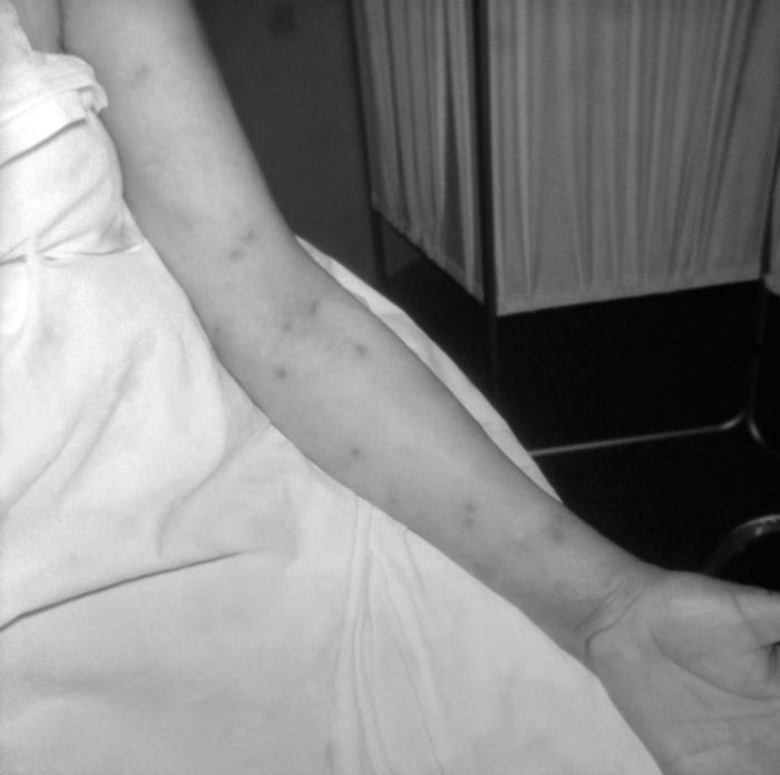 Photograph of secondary syphilitic papular rash on a patient’s left arm. A patient with a papular rash on the left arm that developed during secondary syphilis. The rash often appears as rough, red or reddish brown spots that can appear on palms of hands, soles of feet, the chest and back, or other parts of the body. Adapted from CDC