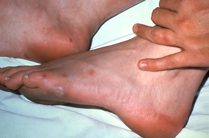 This patient presented with cutaneous foot lesions that were diagnosed as a disseminated gonococcal infection. Gonorrhea is the most frequently reported communicable disease in the U.S. Disseminated gonococcal infection is most often the cause of acute septic arthritis in sexually active adults, and the reason for most hospitalizations due to infective arthritis. Adapted from CDC