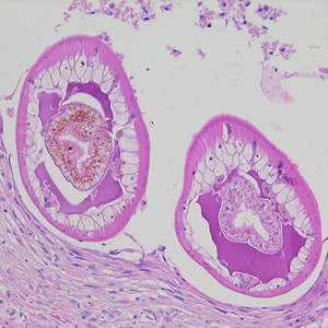 Cross-sections of larvae of D. renal in a subcutaneous nodule, stained with hematoxylin and eosin (H&E). Images courtesy of the Laboratory of Parasitology, National Public Health Research Center in Vilnius, Lithuania. Adapted from CDC