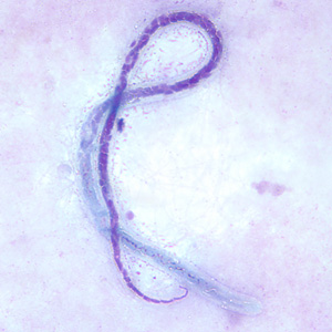 Microfilaria of M. ozzardi in a thick blood smear, stained with Giemsa. Note the hook-like end to the tail in this figure. Adapted from CDC