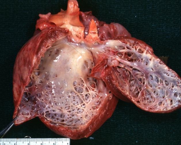 Dilated Cardiomyopathy: Gross dilated left ventricle with marked endocardial sclerosis (an excellent example)