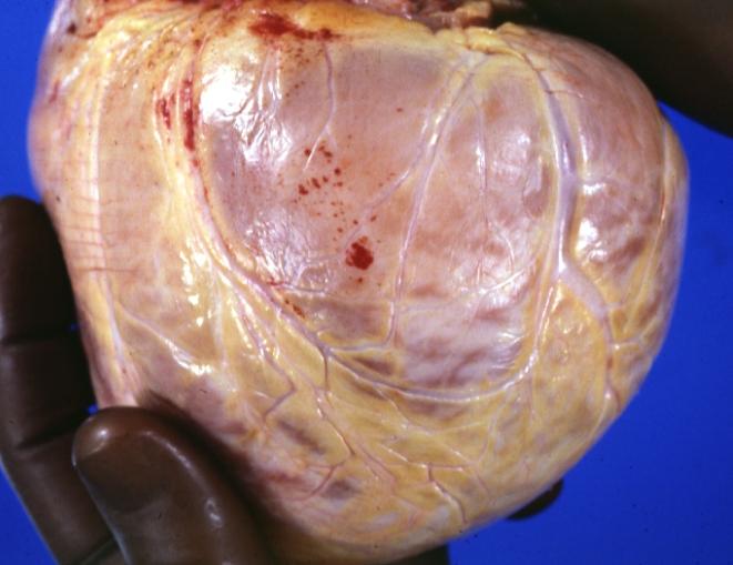 Cardiomyopathy: Gross external view of globular heart with patchy fibrosis seen through epicardium