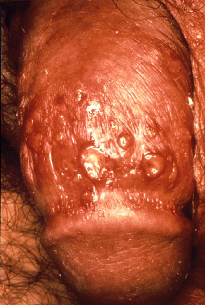 This male patient presented with a maculopapular herpetic rash on the penile shaft and corona of the glans penis. When signs of genital herpes do occur, they typically appear as one or more blisters on or around the genitals or rectum. The blisters break, leaving tender ulcers (sores) that may take two to four weeks to heal the first time they appear. Adapted from CDC