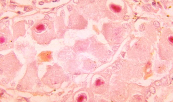 Histopathology of cytomegalovirus infection of kidney tubule epithelial cells. Lendrum stain. From Public Health Image Library (PHIL). [1]