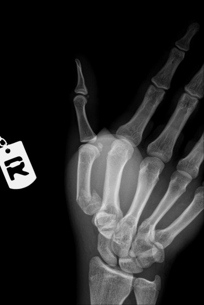 Frontal-deviated Fracture of base of the first metacarpal bone with mild to moderate displacement and without intra-articular extension.