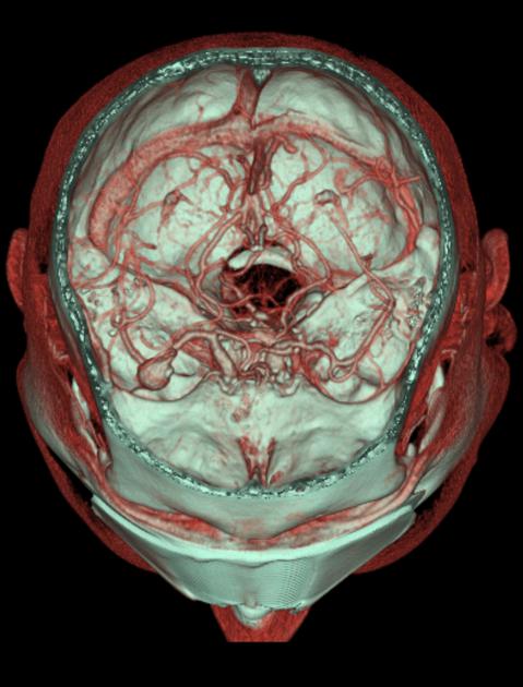 File:CT angiogram .jpg