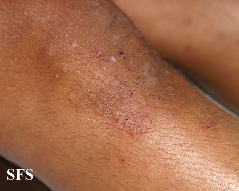 File:Dermatitis herpetiformis35.jpg