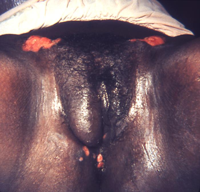 This female patient presented with a case of granuloma inguinale with coexisting secondary syphilis. See PHIL 3485 and 18895, for additional views of this patient's condition. Granuloma inguinale, like syphilis, is also a sexually transmitted disease. It is a slowly progressive ulcerative condition of the skin and lymphatics of the genital, and perianal area caused by infection with Calymmatobacterium granulomatis. Adapted from CDC