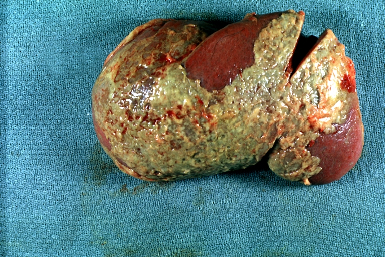 Spleen: Subphrenic Abscess: Gross spleen capsule coated with green pus