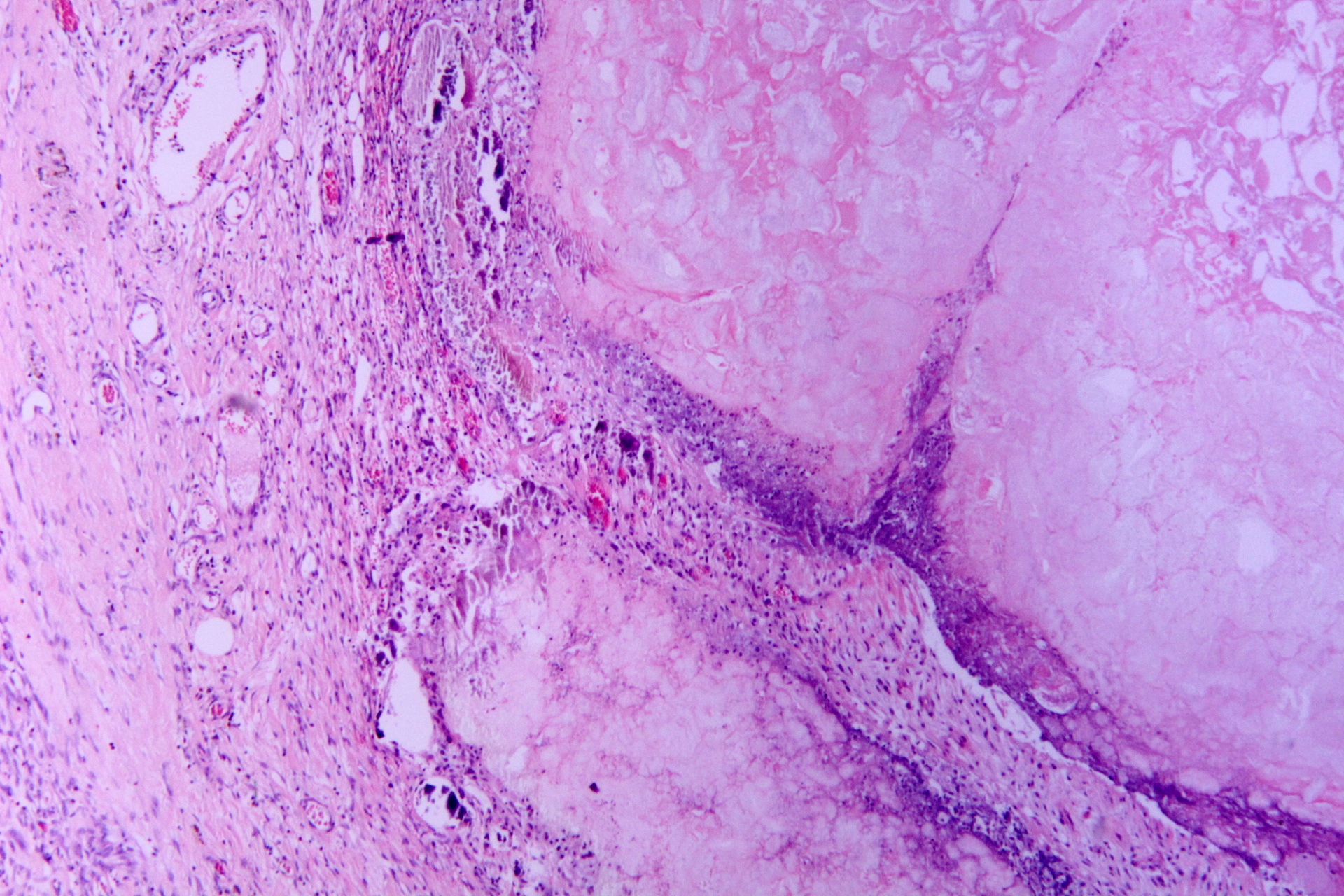 File:Tryptic fat tissue necrosis in severe pancreatitis, HE 2.jpg