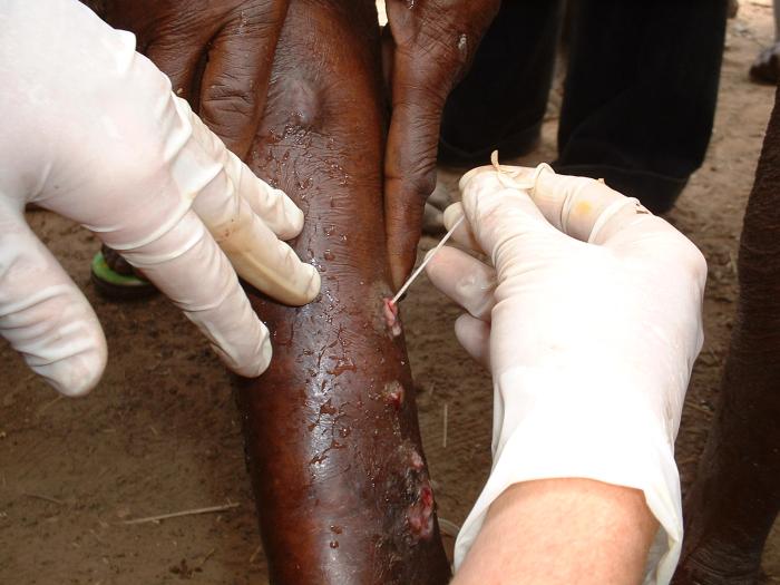 Subcutaneous emergence of a female Guinea worm, Dracunculus medinensis, from a sufferer’s lower leg. From Public Health Image Library (PHIL). [8]