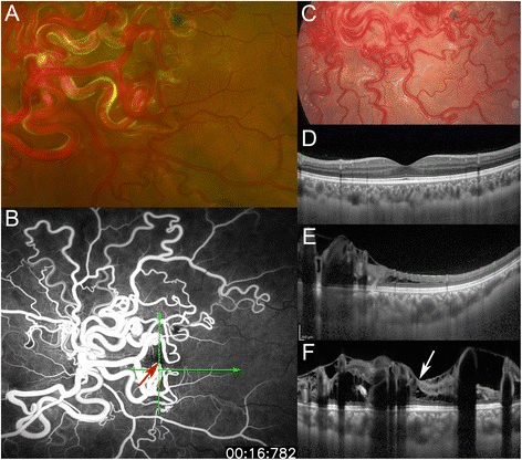 File:Fundus photographs, fluorescein angiographic (FA) image, and enhanced depth imaging optical coherence tomographic (EDI- OCT).gif