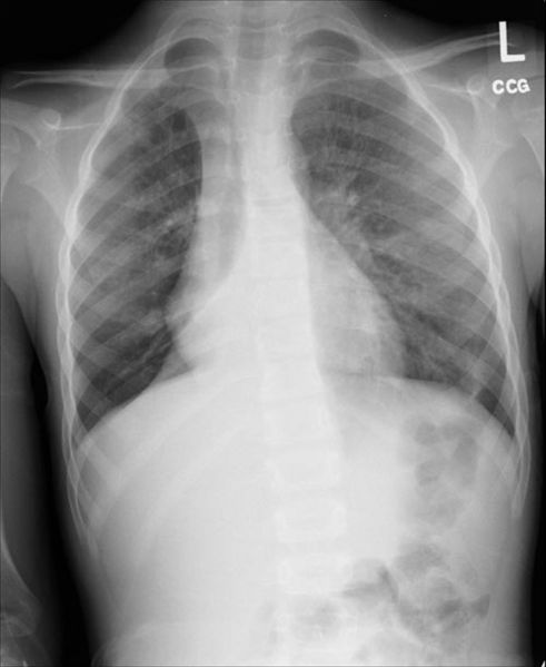 Right lower lobe collapse