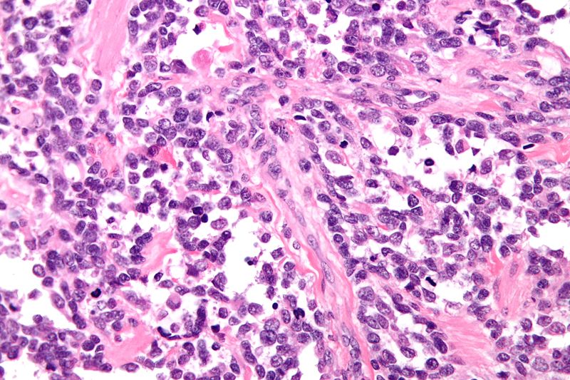 File:800px-Alveolar rhabdomyosarcoma - very high mag.jpg