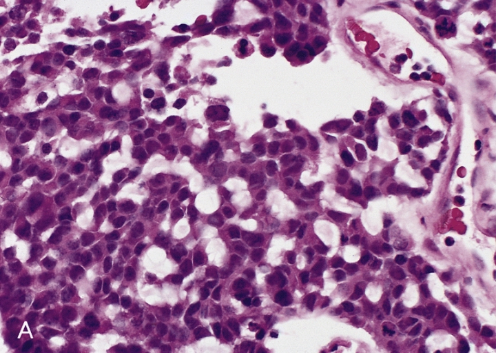 Adrenocortical carcinoma microscopic picture, source: By AFIP Atlas of Tumor Pathology - [1], Public Domain, https://commons.wikimedia.org/w/index.php?curid=6719510