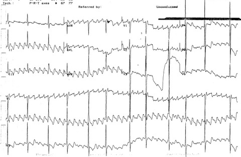 Typical atrial flutter pattern
