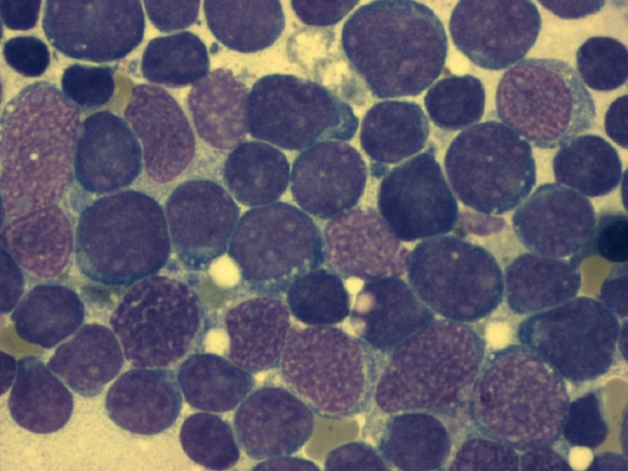 bone marrow smear (large magnification) from a patient with acute lymphoblastic leukemia
