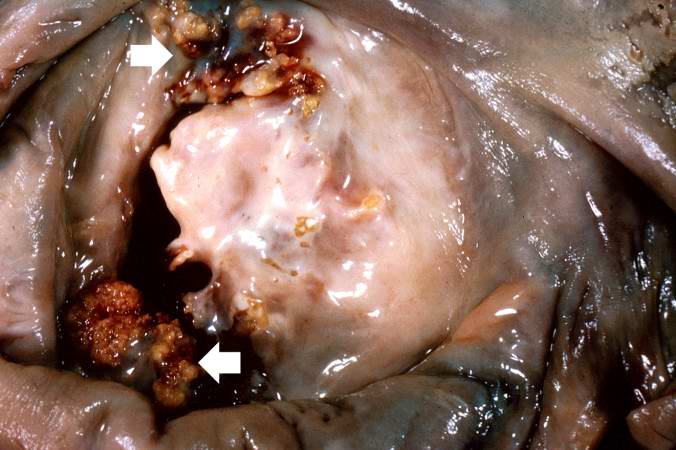 This is a gross photograph of mitral valve demonstrating marked thickening and fibrosis of the valve leaflet. There are also numerous foci of fibrinoid necrosis within the cusps and friable vegetations (verrucae) along the lines of closure (arrows). These irregular, warty projections are found at sites of erosion on the inflamed endocardial surface. The verrucae probably result from the precipitation of fibrin where the leaflets impinge on each other.