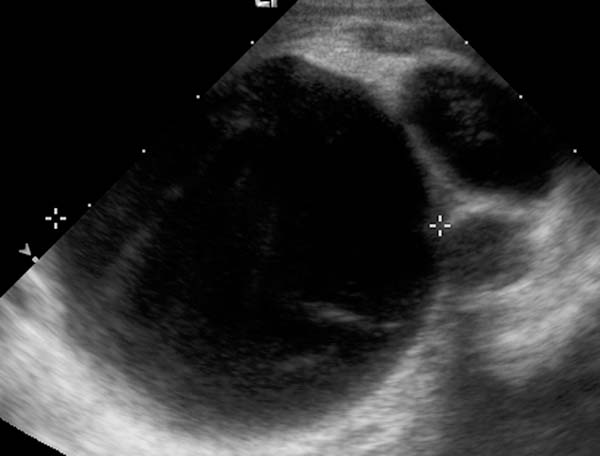 Ultrasonography: Multicystic dysplastic kidney