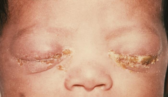 This was a newborn with gonococcal ophthalmia neonatorum caused by a maternally transmitted gonococcal infection. Unless preventative measures are taken, it is estimated that gonococcal ophthalmia neonatorum will develop in 28% of infants born to women with gonorrhea. It affects the corneal epithelium causing microbial keratitis, ulceration and perforation. Adapted from CDC