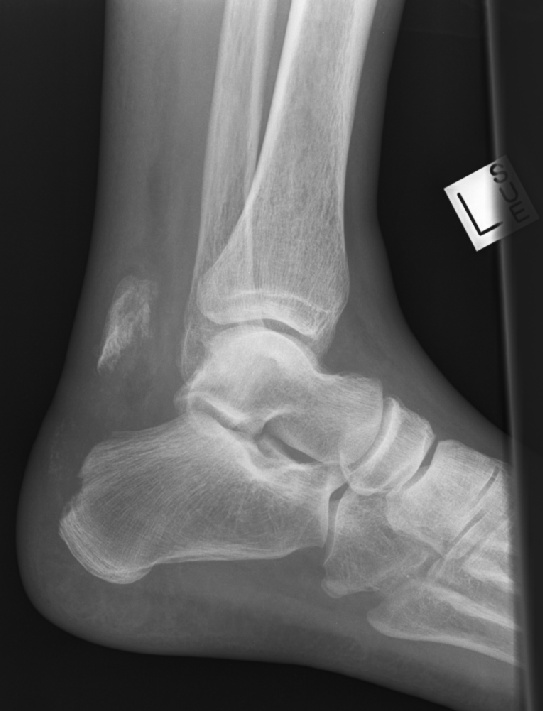 Avulsion fracture at the insertion of the Achilles tendon, with marked separation of fragments.