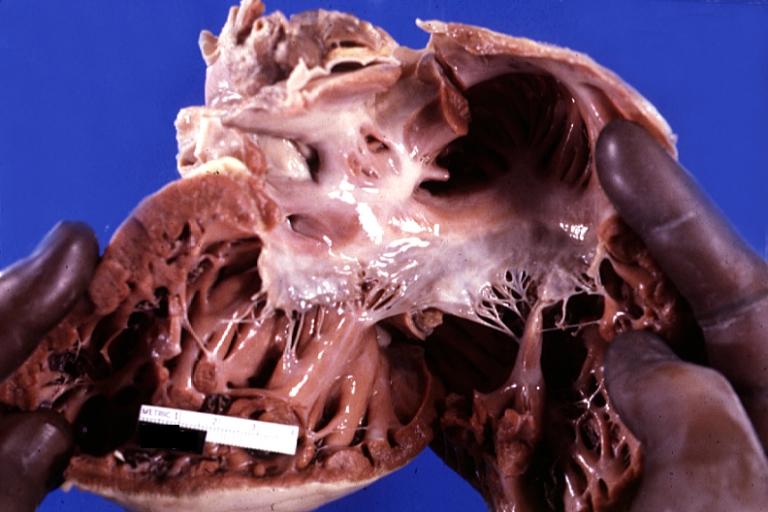 Cor Triatriatum: Gross right atrium tricuspid valve and right ventricle note right ventricular hypertrophy