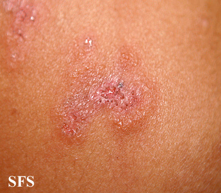File:Dermatitis herpetiformis30.jpg