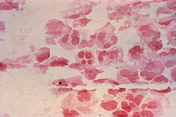 Urethral discharge for Neisseria gonorrhea revealed Gram-negative intracellular rods, NOT diplococci. From Public Health Image Library (PHIL). [1]