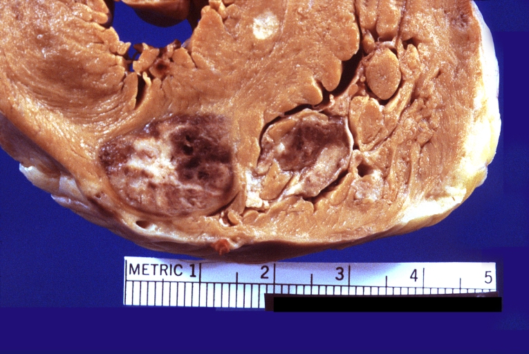 Heart metastases from bronchogenic carcinoma (closer look)