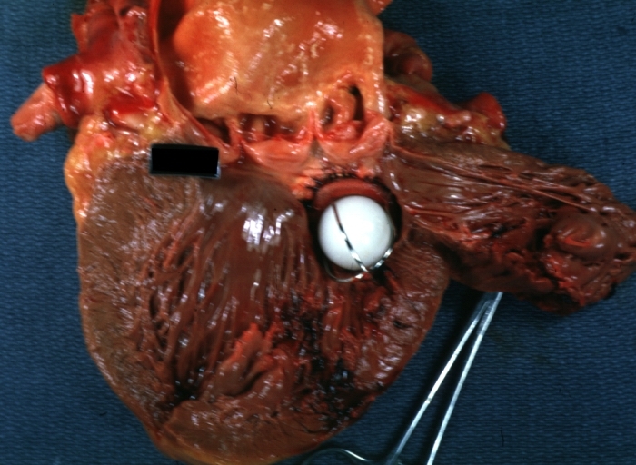 HEART: Myocardial Rupture Following Mitral Valve Replacement: Gross, natural color view from within left ventricle caged plastic ball with steel complete struts [11]