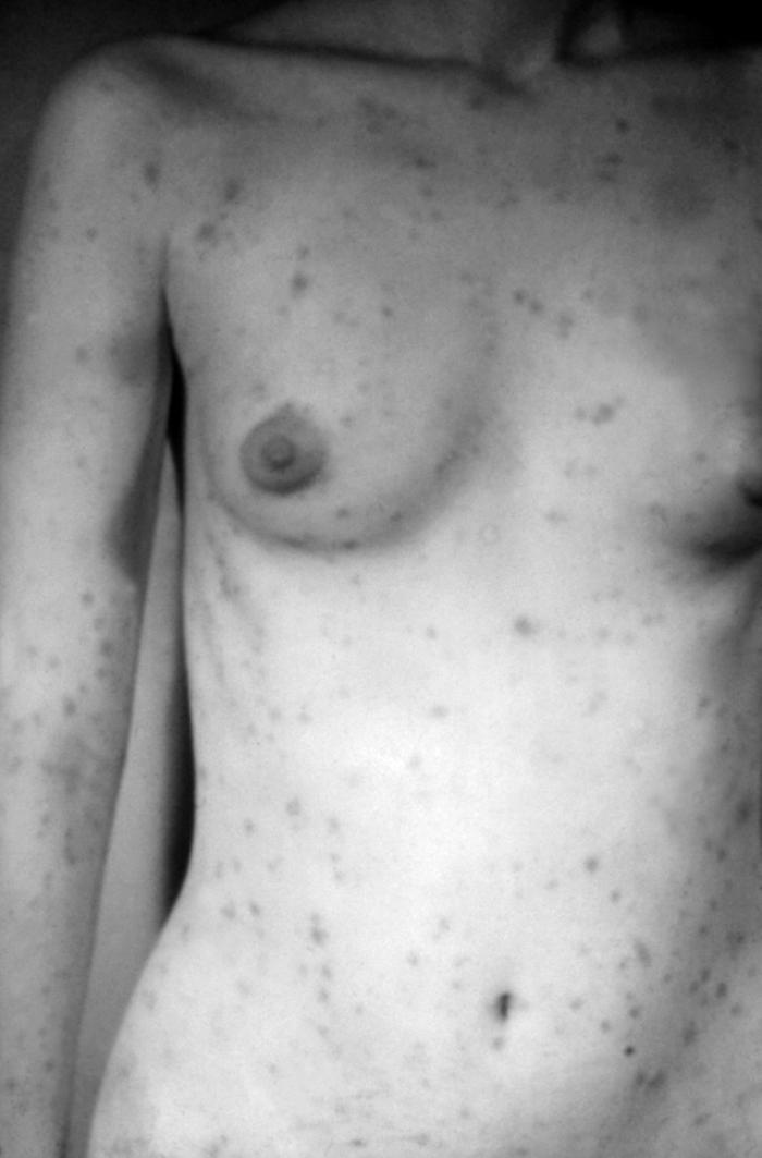 A photograph of a secondary syphilitic papulosquamous rash seen on the torso and upper body. This patient had an extensive papulosquamous rash that developed during secondary syphilis. The rash often appears as rough, red or reddish brown spots that can appear on palms of hands, soles of feet, the chest and back, or other parts of the body Adapted from CDC