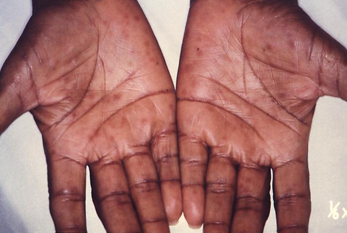 These were secondary syphilitic lesions on the palms of a 60 yr old woman. See PHIL 17051, for another image of this patient depicting a cutaneous labial lesion, which was also attributed to this illness. Syphilis is a complex sexually transmitted disease (STD) caused by the bacterium Treponema pallidum. It has often been called "the great imitator" because so many of the signs and symptoms are indistinguishable from those of other diseases. Adapted from CDC
