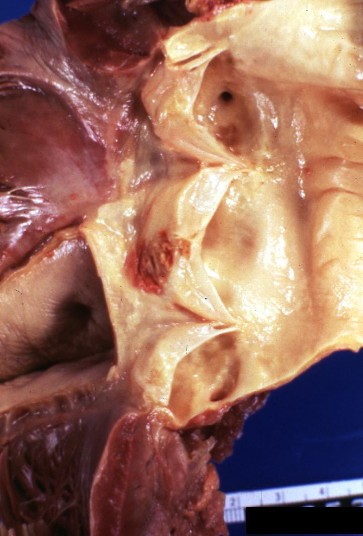 Bacterial Endocarditis: (Gross) A lesion on non-coronary cusp of aortic valve.