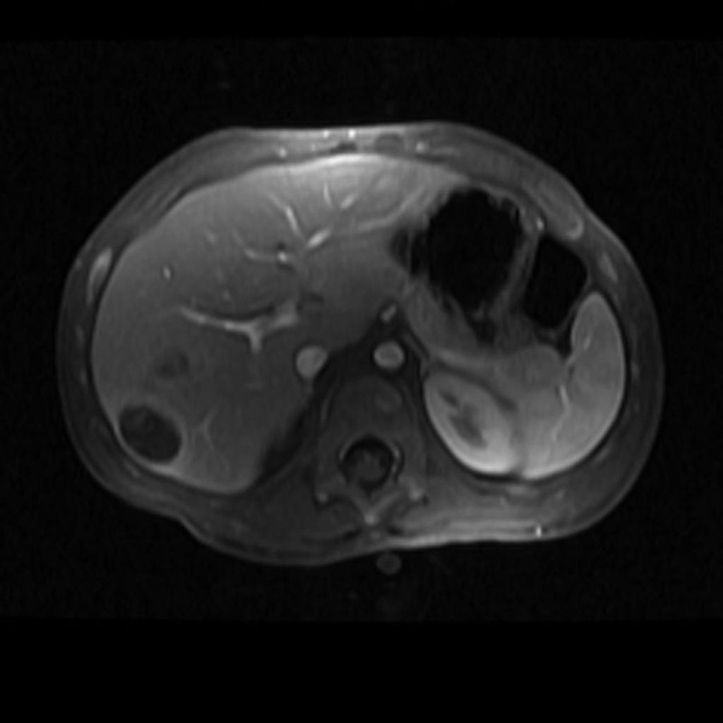 File:Hepatoblastoma-1.jpg