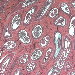 Adult of O. volvulus in a subcutaneous nodule, stained with H&E. Adapted from CDC