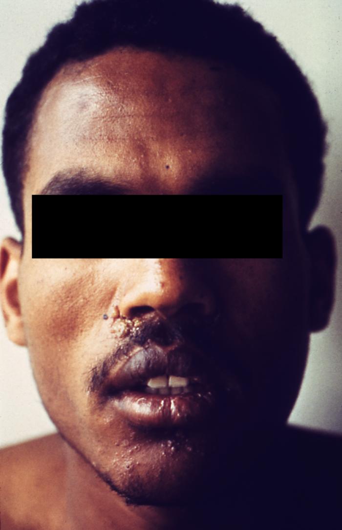 This patient presented with secondary annular syphilitic lesions of the face. Second-stage symptoms can include fever, swollen lymph glands, sore throat, patchy hair loss, headaches, weight loss, muscle aches, and tiredness. A person can easily pass the disease to sex partners during the primary or secondary stage of the disease. Adapted from CDC