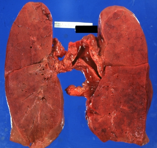 Kidney: Lupus Erythematosus: Micro high mag H&E increased mesangial tissue and wire loops 10yo female with renal failure and TIAs due to Libman Sacks endocarditis