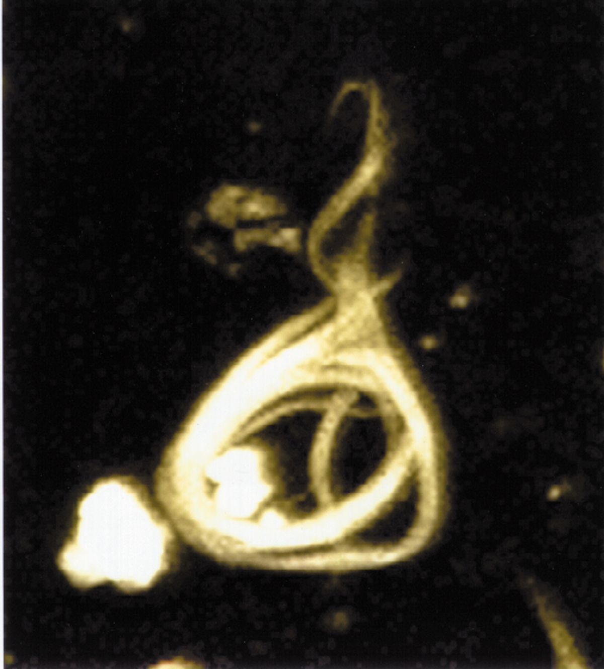 Microscopy image of a neurofibrillary tangle, conformed by hyperphosphorylated tau protein.