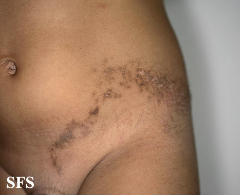 Inflammatory linear verrucous naevi. Adapted from Dermatology Atlas.[3]
