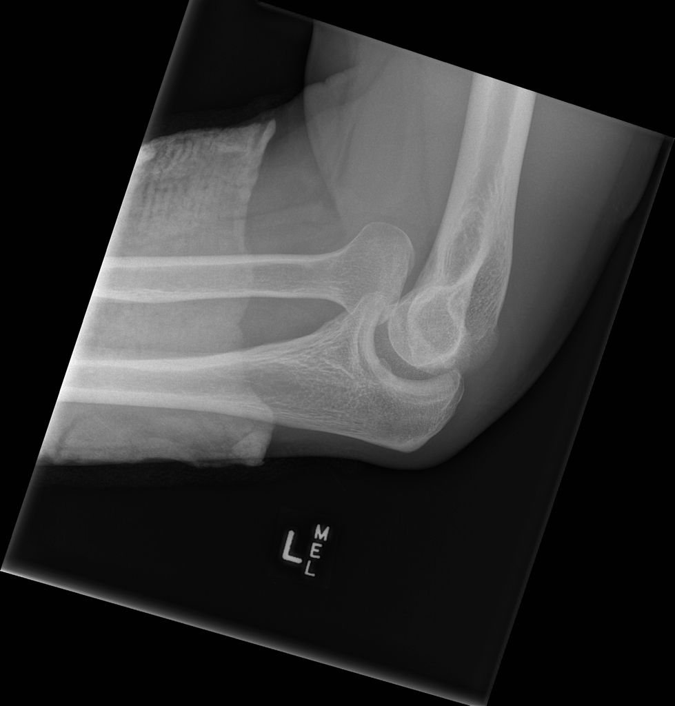 File:Monteggia-fractures2.jpg