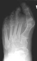Second toe amputation with resultant hallux valgus deformity. This is a common complication of second toe amputations and occurs because the great toe tends to drift toward the third to fill the gap left by the amputation. (Courtesy of A. Gentili MD)